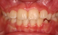 Closeup of young girl's smile after orthodontic treatment