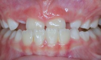Closeup of young girl's smile before orthodontic treatment
