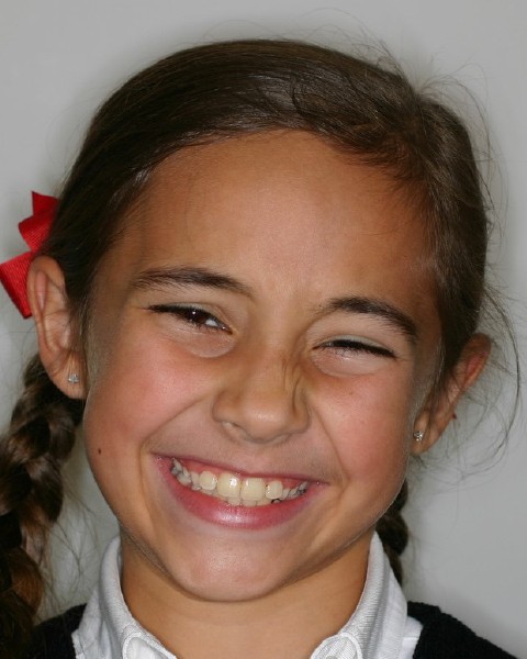 Young girl smiling after orthodontic treatment