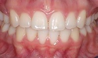 Closeup of preteen girl's smile after orthodontic treatment