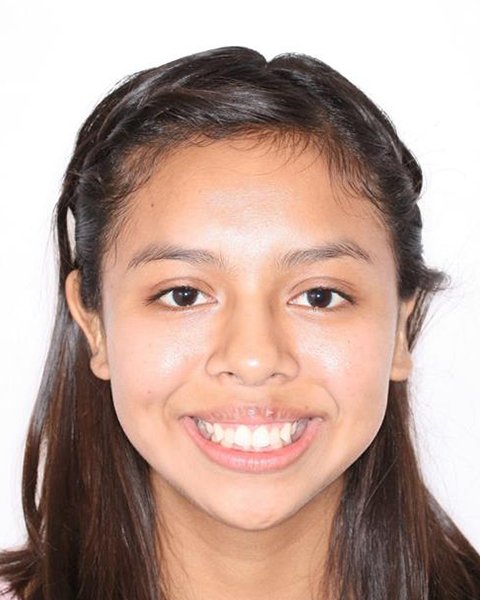 Preteen girl smiling before orthodontic treatment