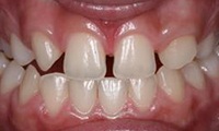 Closeup of teen girl's smile before orthodontic treatment