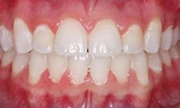 Closeup of teen girl's aligned smile after orthodontic treatment