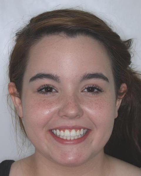 Teen girl with aligned smile after orthodontic treatment