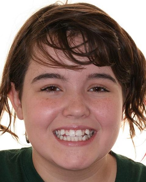 Teen girl with misaligned smile before orthodontic treatment