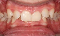 Closeup of teen girl's overbite before orthodontic treatment