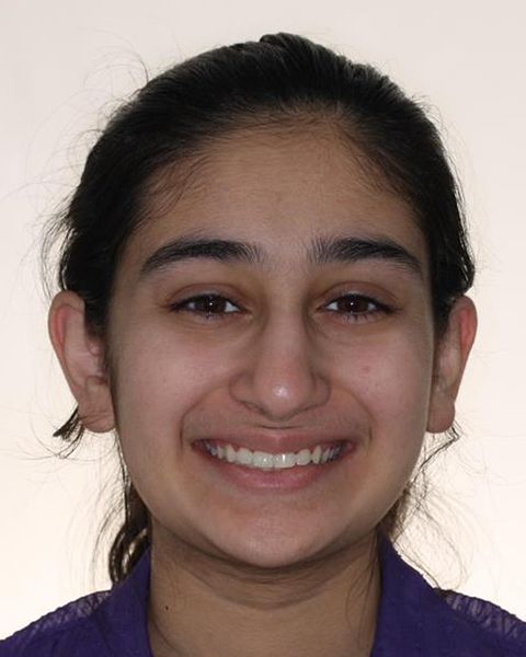 Teen girl with corrected bite after orthodontic treatment
