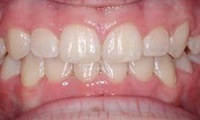 Closeup of young female patient's smile after orthodontic treatment