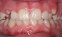 Closeup of young female patient's smile before orthodontic treatment