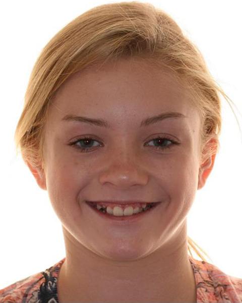 Young female patient before orthodontic treatment
