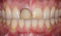 Closeup of teen girl's damaged and misaligned smile before orthodontic treatment