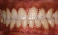 Closeup of adult patient's smile after orthodontic treatment