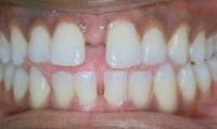 Closeup of adult patient's smile before orthodontic treatment