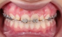 Closeup of young girl's smile with phase one orthodontics