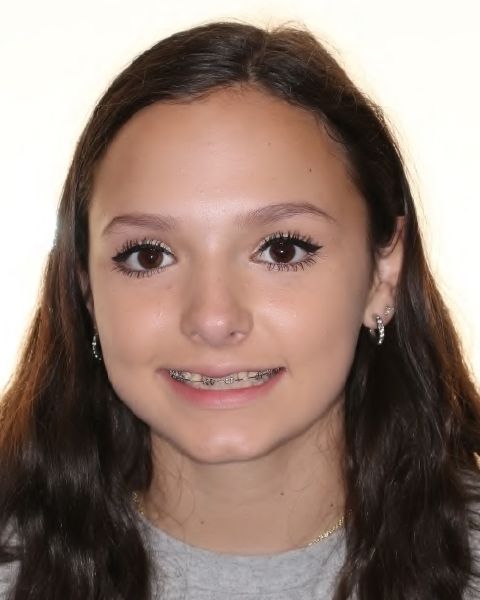 Young girl with phase one orthodontics