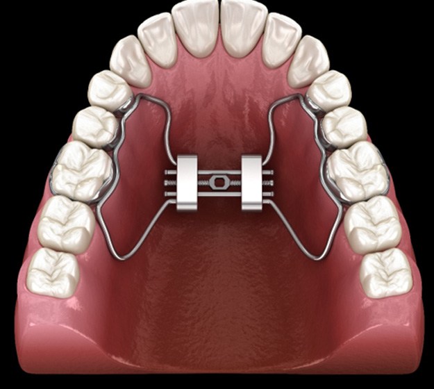 A palate expander in Plano 