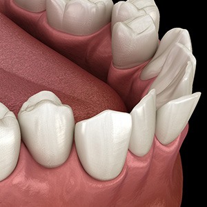 Illustration of crowded teeth