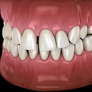 Illustration of gapped teeth