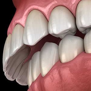 Illustration of an overbite