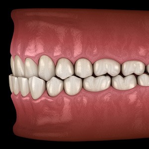 Illustration of an underbite