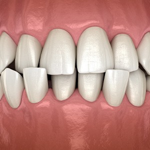 Illustration of a crossbite