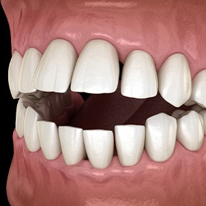 Illustration of an open bite