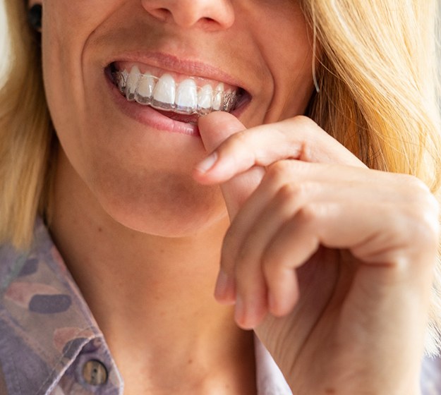 Man putting in Invisalign aligners