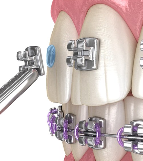 A digital image of metal brackets being placed onto the surface of each tooth