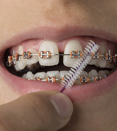 A person using an interdental brush to clean between their brackets and underneath the metal wire