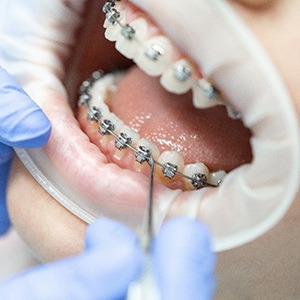 close up of braces with multicolored brackets 