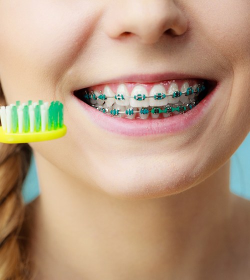 An up-close look at a female preparing to brush her teeth and braces using a manual toothbrush
