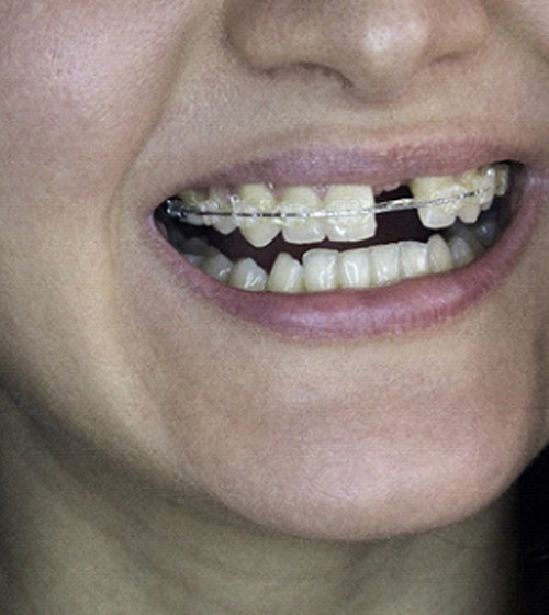 Close-up of woman with missing teeth wearing braces in Plano, TX