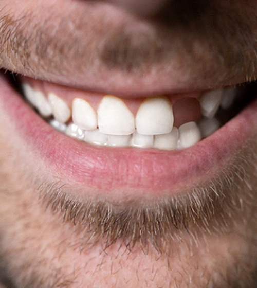 Close-up of bearded man with missing tooth smiling