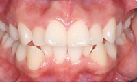 Closeup of preteen girl's smile before orthodontic treatment