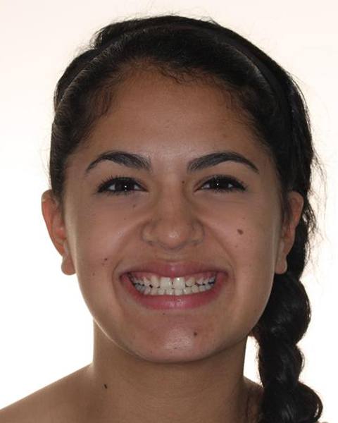 Teen girl smiling before orthodontic treatment