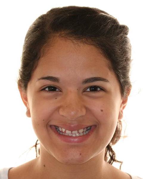Teen girl smiling before orthodontic treatment