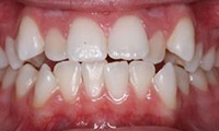 Closeup of teen girl's smile before orthodontic treatment