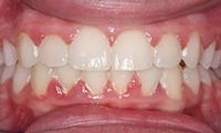 Closeup of teen girl's corrected bite after orthodontic treatment