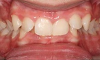 Closeup of teen girl's overbite before orthodontic treatment
