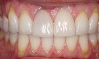 Closeup of teen girl's healthy aligned smile after orthodontic treatment