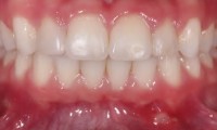 Closeup of Young girl's smile after phase one orthodontics