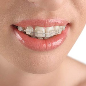 Close-up of woman’s smile with professional clear braces