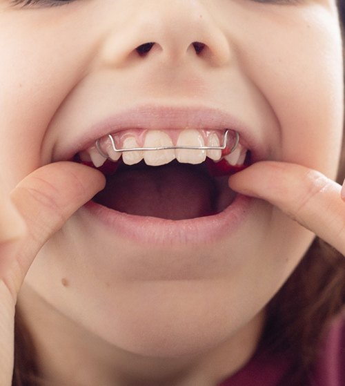 Child using an oral appliance for orthodontic retention 