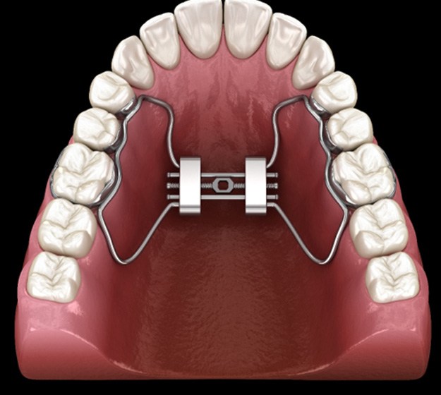 A palate expander in Plano