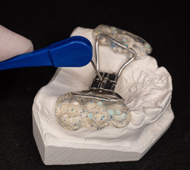 A palate expander in Plano