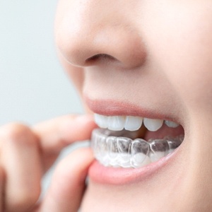An up-close image of a person inserting their Invisalign aligner in the lower arch of the mouth in Plano