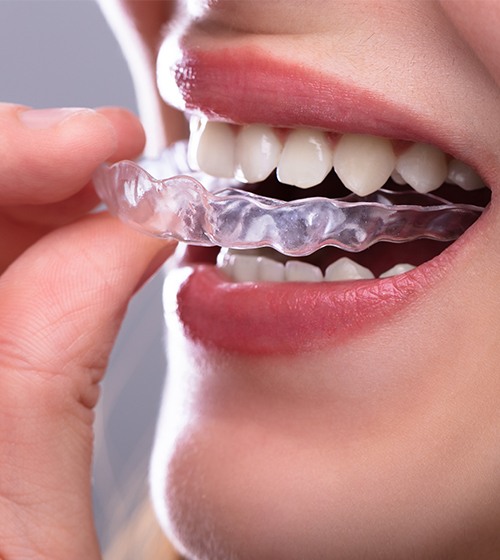 invisalign clear correct aligners teeth dental tray braces adult benefits amazing aligner treatment