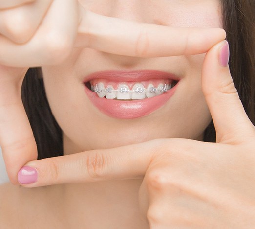 Woman with self-ligating braces using hands to frame her smile
