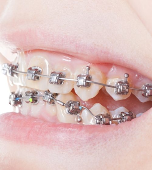 Close-up of woman’s smile with self-ligating braces in Plano