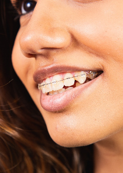 A woman with clear braces